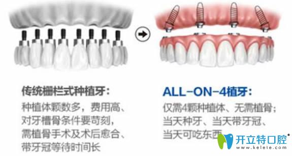 all-on-4種植牙技術(shù)和傳統(tǒng)種植牙區(qū)別圖示