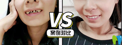 牙博士口腔怎么樣？看牙齒全瓷冠修復案例前后對比圖