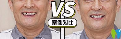 牙博士口腔好嗎？看牙博士種牙案例效果