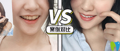 青島牙博士口腔好不好？看牙齒美白真人案例來驗證
