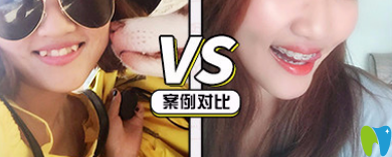 青島牙博士口腔靠譜嗎？牙博士口腔半隱形牙齒矯正案例來證明