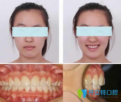 我在無(wú)錫通善口腔做隱形齙牙矯正一年后效果