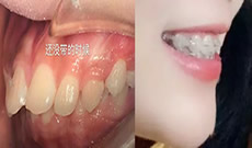 來看我在沈陽歡樂口腔戴半隱形牙套前后效果圖 歷時665天
