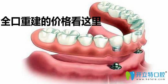 全口重建的價格在這里