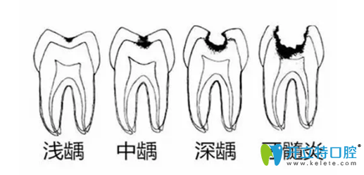 齲齒發(fā)展過程圖