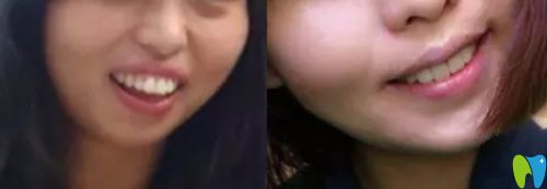 重慶牙科哪家好，看美維口腔齙牙矯正案例效果圖
