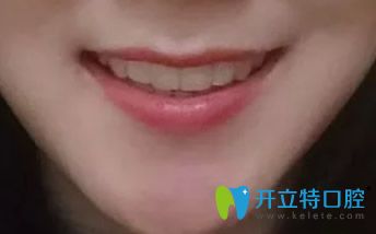 結(jié)束正畸，戴保持器圖片