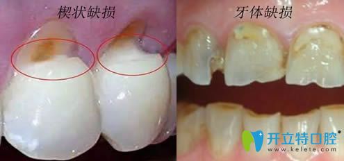 開立特楔狀缺損和牙體缺損對(duì)比圖