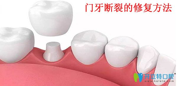 美麗雅口腔門(mén)牙斷裂的修復(fù)方法
