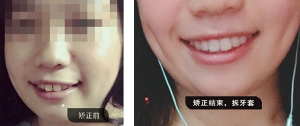 看到廣州德仁口腔正畸效果 朋友問(wèn)我做隱形矯正牙齒多少錢