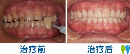 歡悅口腔3D超薄瓷貼面修復(fù)牙齒案例
