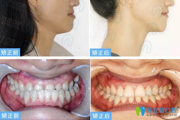 杭州齊爾口腔地包天牙齒矯正案例