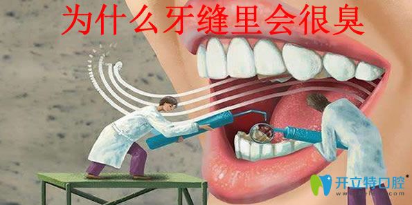快來圍觀牙縫臭怎么辦 為你揭曉牙縫臭的原因和解決方法
