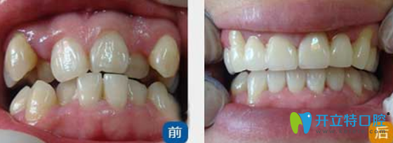 天津美萊口腔好不好？看牙齒矯正案例效果來驗證
