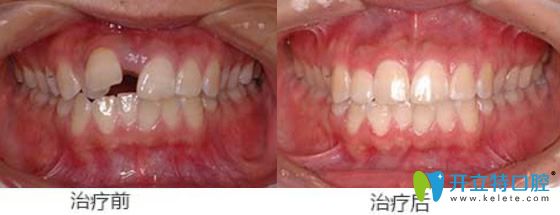 屬于天津美萊口腔的牙齒錯(cuò)位、牙間縫矯正案例