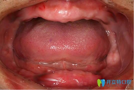 我?guī)Я?0年的活動假牙，沒做種植牙卻讓活動假牙害我一生啊