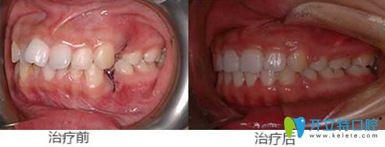 天津美萊口腔牙齒擁擠鎖頜矯正案例對比圖