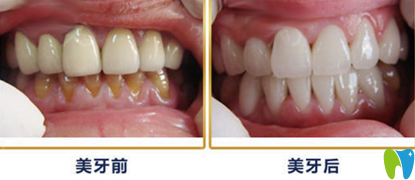 牙衛(wèi)士口腔5D納米全瓷貼面術前術后對比案例