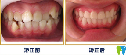 重慶牙衛(wèi)士口腔牙齒矯正案例前后效果對比圖