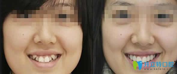 南昌安植雅口腔虎牙矯正前后對(duì)比圖