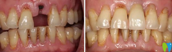 武漢第 一口腔陳東平種植牙案例對(duì)比圖