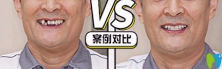 泉州牙博士好不好？牙博士單顆牙缺失即刻種植案例來證明