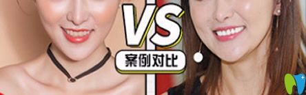 牙博士口腔泉州補牙哪家好？來看牙博士口腔補牙治療前后對比案例