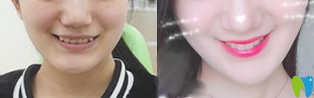 泉州牙博士矯正怎么樣？來看牙博士虎牙和深覆頜隱形矯正前后效果對比