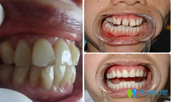 天津美奧隱形牙齒矯正前后對比照
