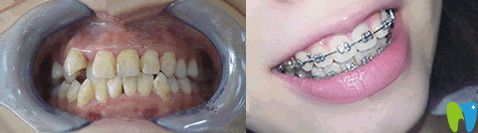 北京誠之康口腔正畸怎么樣？來看對(duì)比圖