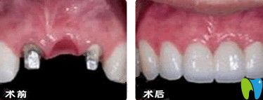 北京誠(chéng)之康口腔種植牙前后對(duì)比圖