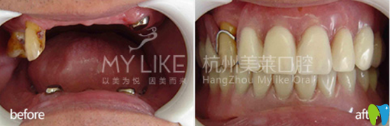 美萊口腔老年活動義齒修復(fù)缺牙牙齒案例對比圖