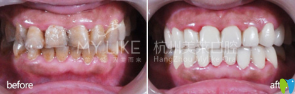 杭州美萊口腔明星全瓷牙修復(fù)牙齒案例前后效果對比