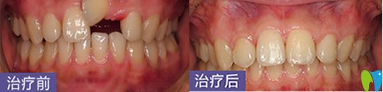 深圳烤瓷牙哪家好？鵬程口腔牙齒修復(fù)案例來嘍