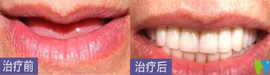深圳哪家種植牙好？看深圳鵬程口腔種植牙案例