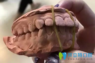 圍觀我花5萬多讓廈門賽德陽光洪慈憶做的齙牙矯正怎么樣？