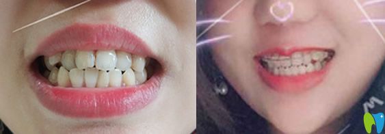 在北京溪美康口腔做牙齒矯正后效果對比
