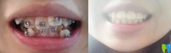 在泉興口腔拔了4顆牙矯正后的牙齒對比圖