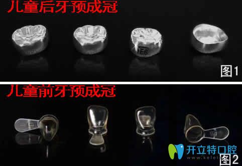 兒童預(yù)成冠對牙齒有沒有危害及戴預(yù)成冠后注意事項(xiàng)的詳解