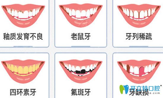 前牙美學(xué)修復(fù)過(guò)程及適應(yīng)癥