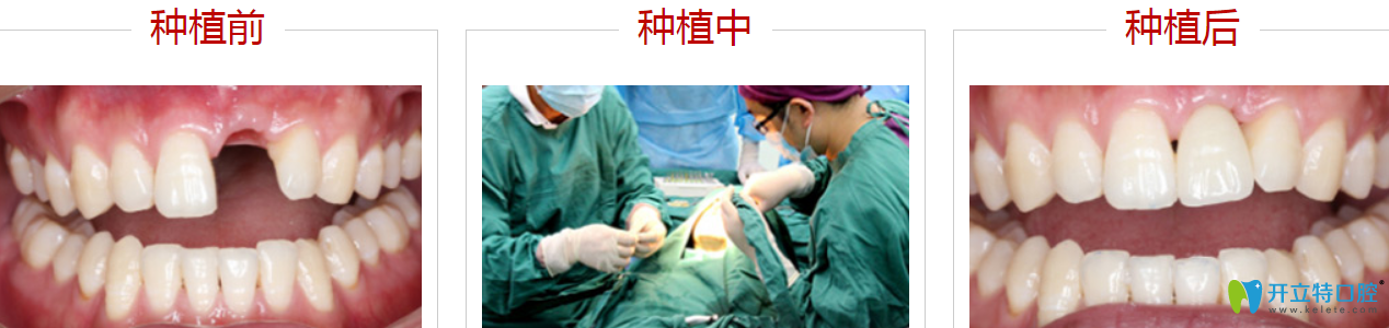 深圳哪里種牙比較好？來看格倫菲爾種植牙案例