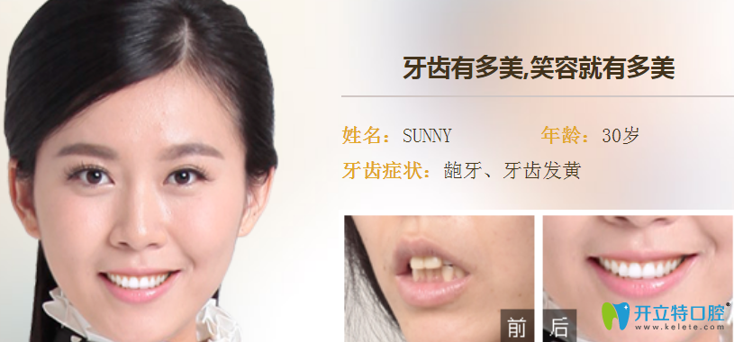 屬于廣州德倫口腔齙牙隱形矯正案例效果對(duì)比圖