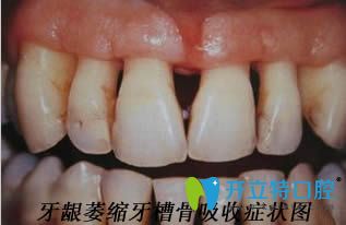 醫(yī)生:我年紀輕輕就牙齦萎縮牙槽骨吸收該怎么治療和預防呢?