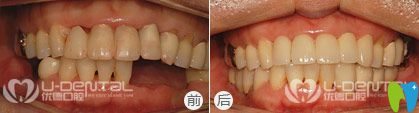 西安優(yōu)德口腔微創(chuàng)無痛種植牙案例圖