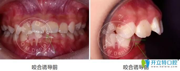 兒童咬合誘導(dǎo)哪家好？深圳青苗口腔羅慕咬合矯正案例驗(yàn)證