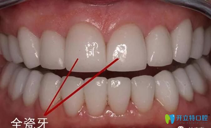 全瓷牙產(chǎn)地影響價(jià)格的，來(lái)看深圳進(jìn)口/國(guó)產(chǎn)全瓷牙多少錢一顆