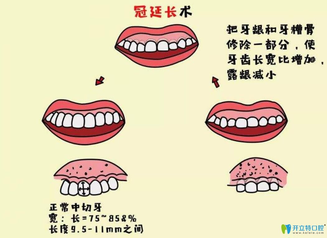 牙冠延長術(shù)是什么，有什么作用