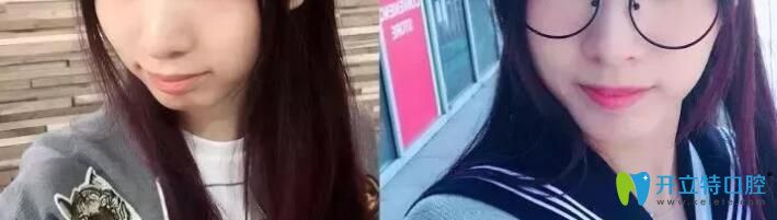 青島維樂口腔梁騰怎么樣？牙齒矯正案例效果來揭曉