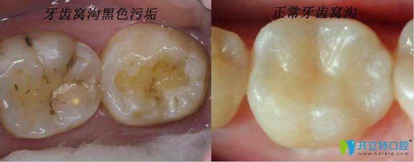 牙齒上的黑色污垢是蛀牙嗎？那蛀牙如何讓它停止腐蝕呢？