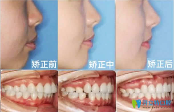 洛陽拜博隱適美齙牙矯正后臉型變化對比圖
